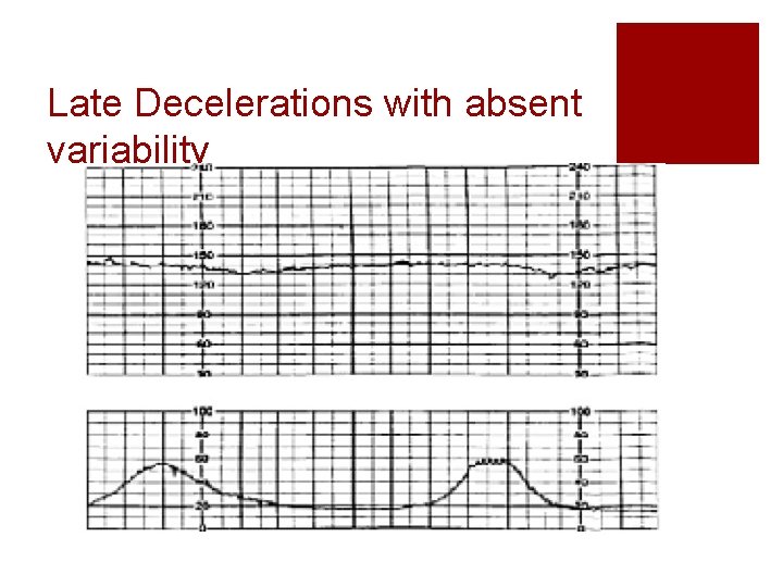 Late Decelerations with absent variability 
