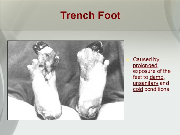 Trench Foot l Caused by prolonged exposure of the feet to damp, unsanitary and