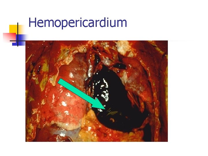 Hemopericardium 