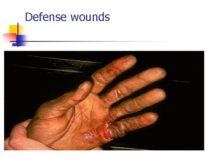 Defense wounds 
