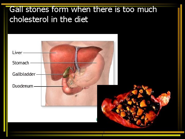 Gall stones form when there is too much cholesterol in the diet 
