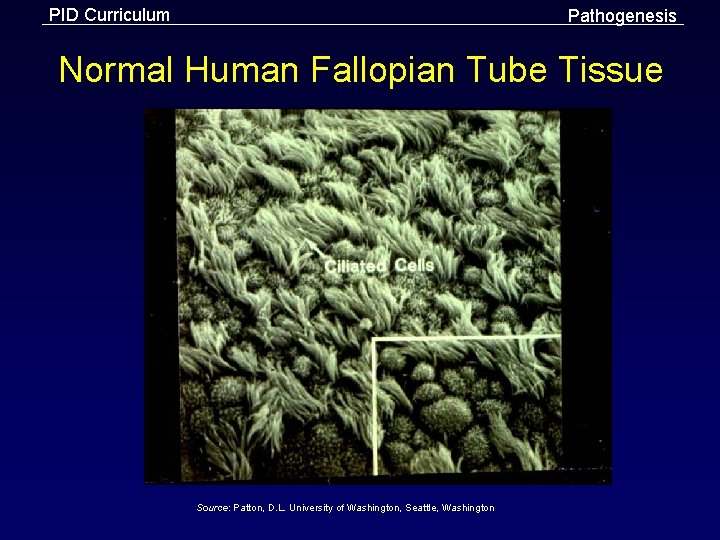 PID Curriculum Pathogenesis Normal Human Fallopian Tube Tissue Source: Patton, D. L. University of