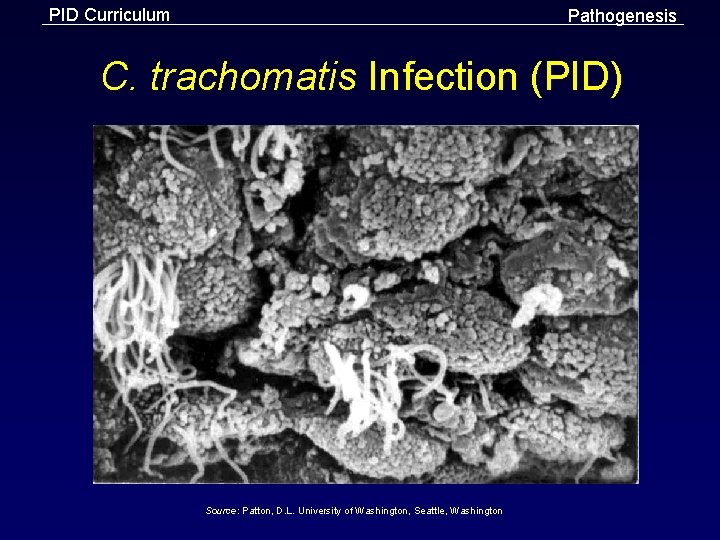 PID Curriculum Pathogenesis C. trachomatis Infection (PID) Source: Patton, D. L. University of Washington,