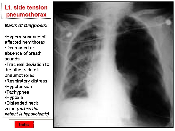 Lt. side tension pneumothorax Basis of Diagnosis: • Hyperresonance of affected hemithorax • Decreased