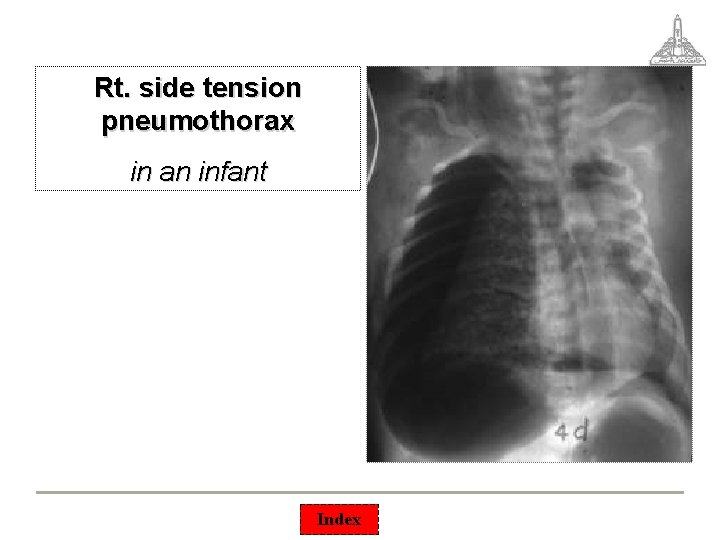 Rt. side tension pneumothorax in an infant Index 