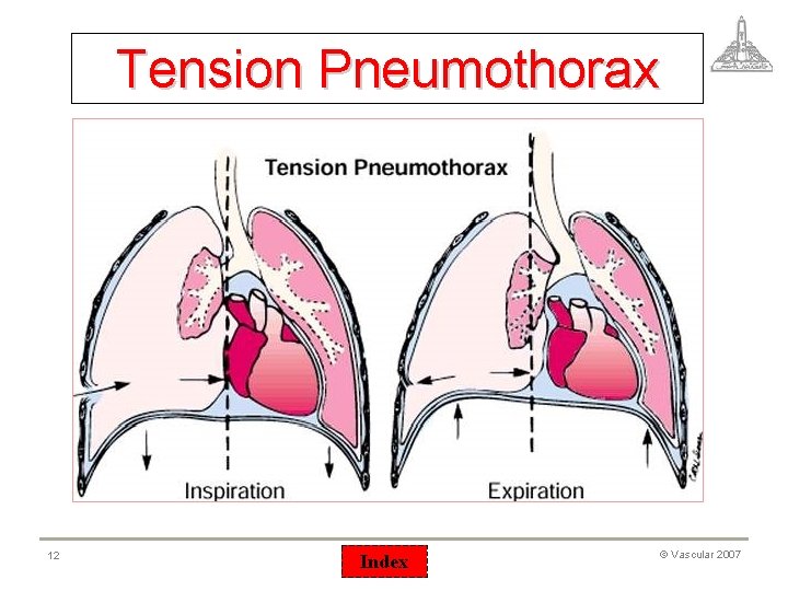 Tension Pneumothorax 12 Index © Vascular 2007 