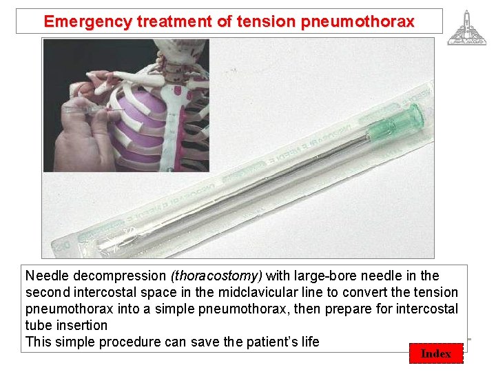 Emergency treatment of tension pneumothorax Needle decompression (thoracostomy) with large-bore needle in the second