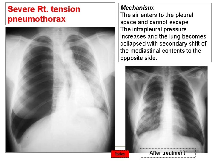 Severe Rt. tension pneumothorax 14 Mechanism: The air enters to the pleural space and