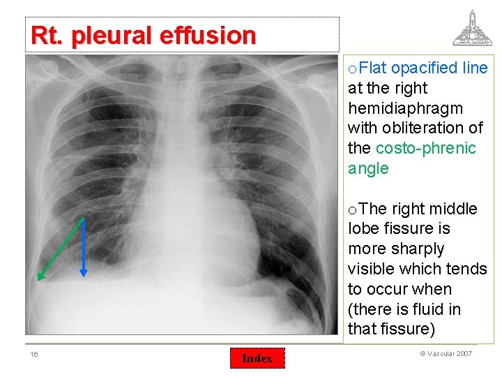 Rt. pleural effusion o. Flat opacified line at the right hemidiaphragm with obliteration of