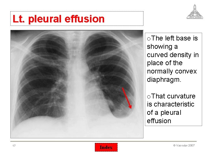 Lt. pleural effusion o. The left base is showing a curved density in place