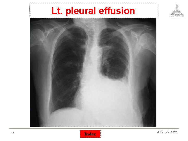 Lt. pleural effusion 18 Index © Vascular 2007 