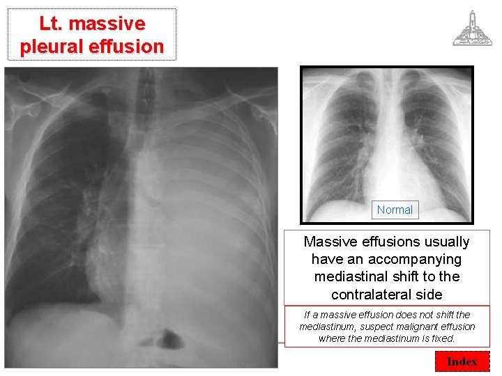 Lt. massive pleural effusion Normal Massive effusions usually have an accompanying mediastinal shift to