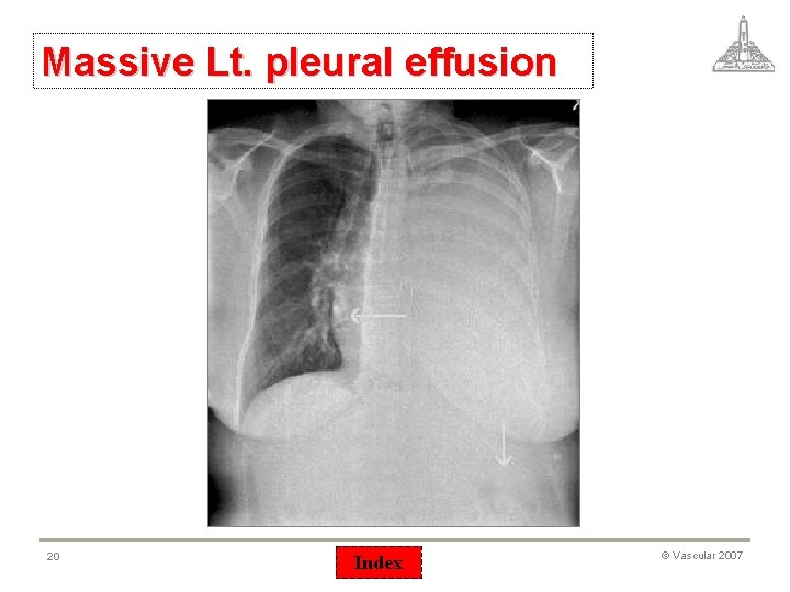 Massive Lt. pleural effusion 20 Index © Vascular 2007 