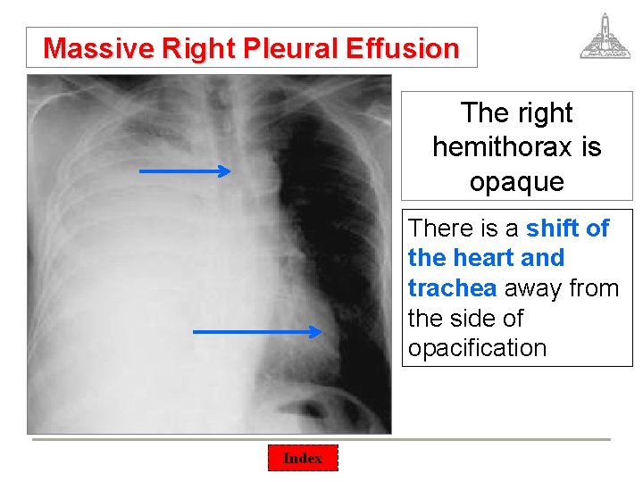 Massive Right Pleural Effusion The right hemithorax is opaque There is a shift of