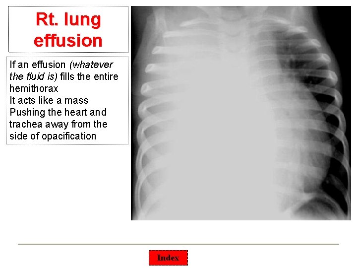 Rt. lung effusion If an effusion (whatever the fluid is) fills the entire hemithorax