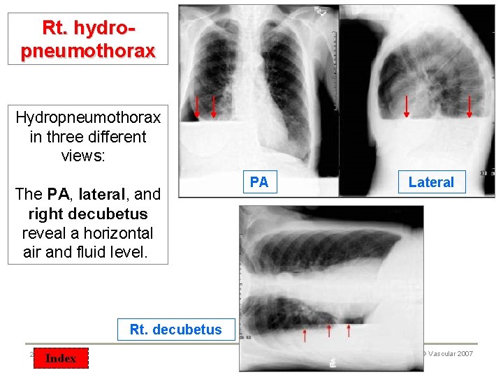Rt. hydropneumothorax Hydropneumothorax in three different views: The PA, lateral, and right decubetus reveal