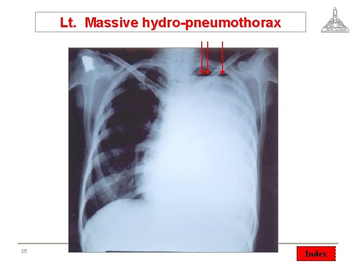 Lt. Massive hydro-pneumothorax 25 © Vascular 2007 Index 