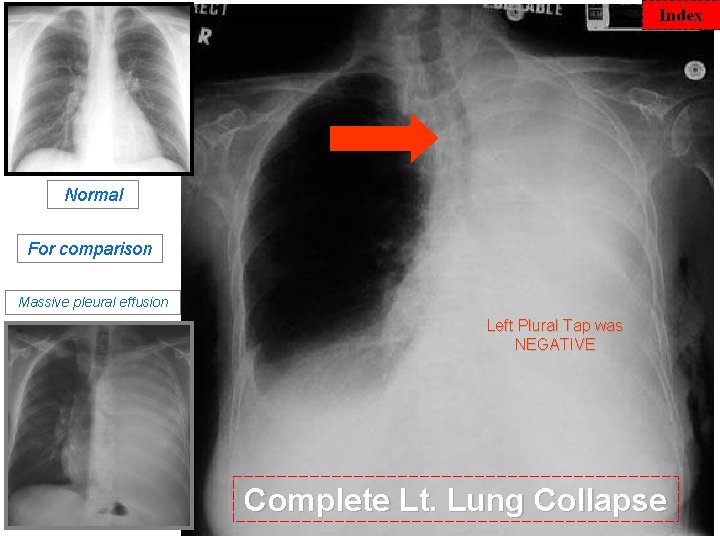 Index Normal For comparison Massive pleural effusion Left Plural Tap was NEGATIVE Complete Lt.