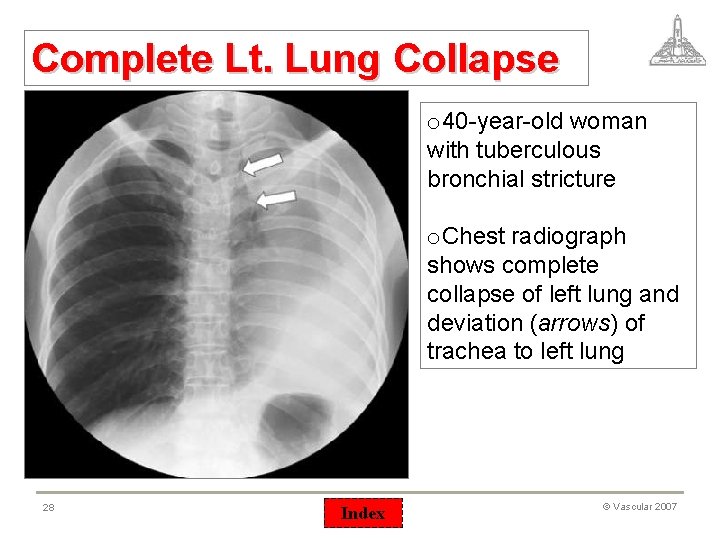 Complete Lt. Lung Collapse o 40 -year-old woman with tuberculous bronchial stricture o. Chest