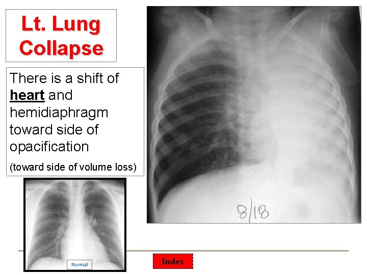 Lt. Lung Collapse There is a shift of heart and hemidiaphragm toward side of