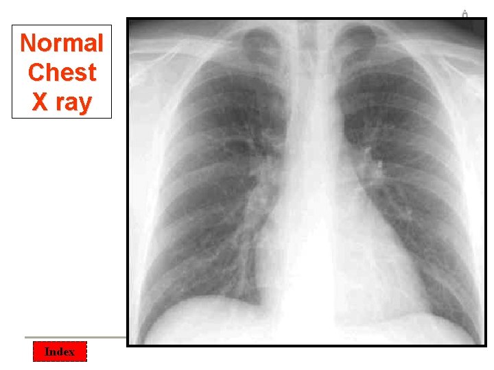 Normal Chest X ray Index 