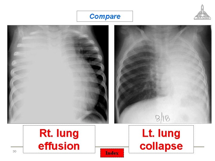 Compare 30 Rt. lung effusion Index Lt. lung collapse 