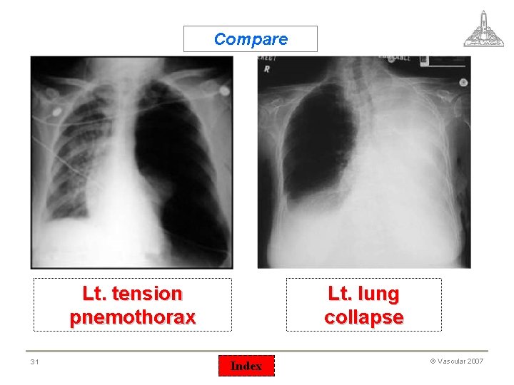 Compare Lt. tension pnemothorax 31 Lt. lung collapse Index © Vascular 2007 