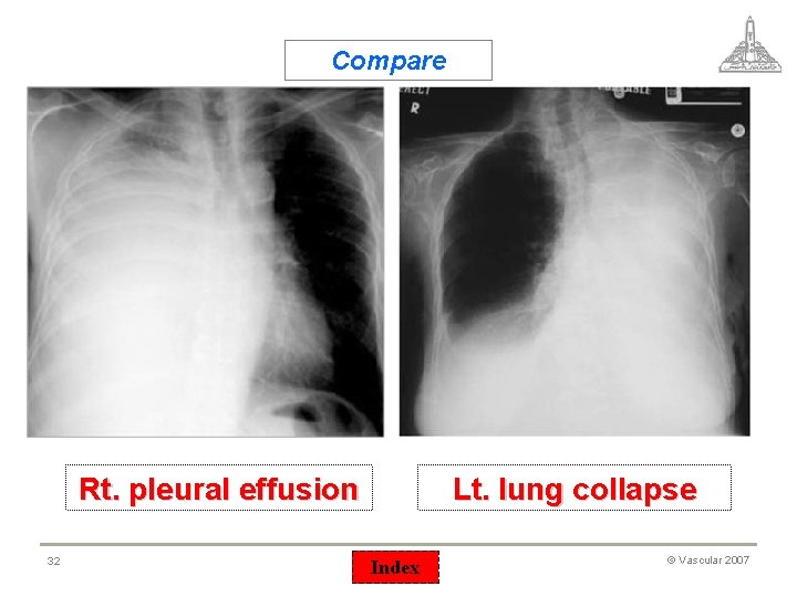 Compare Rt. pleural effusion 32 Lt. lung collapse Index © Vascular 2007 