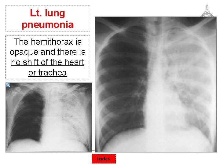 Lt. lung pneumonia The hemithorax is opaque and there is no shift of the