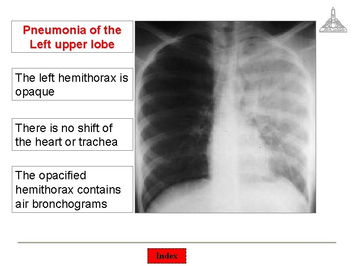 Pneumonia of the Left upper lobe The left hemithorax is opaque There is no