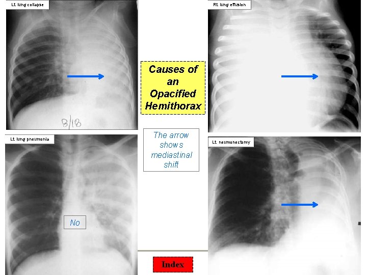 Lt. lung collapse Rt. lung effusion Causes of an Opacified Hemithorax The arrow shows