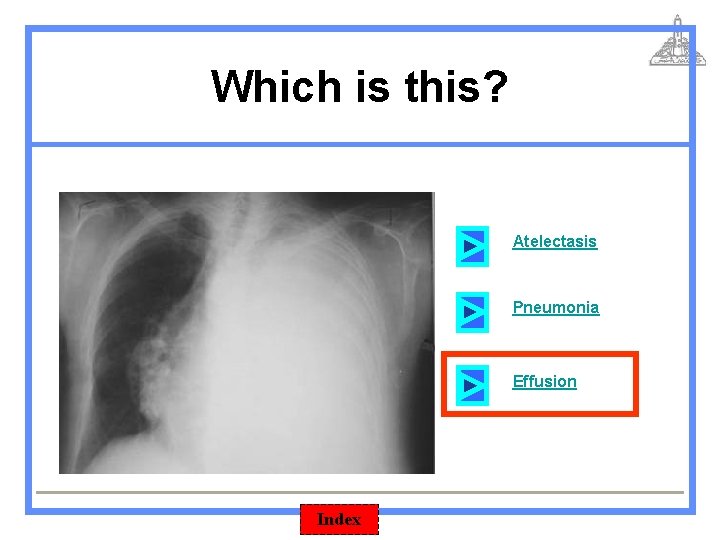 Which is this? Atelectasis Pneumonia Effusion Index 