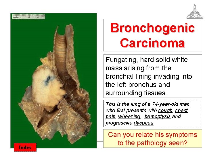 Bronchogenic Carcinoma Fungating, hard solid white mass arising from the bronchial lining invading into