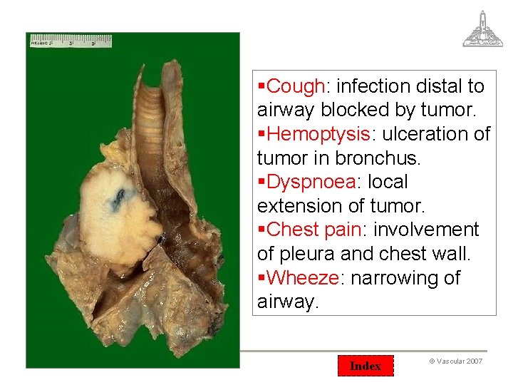 §Cough: infection distal to airway blocked by tumor. §Hemoptysis: ulceration of tumor in bronchus.