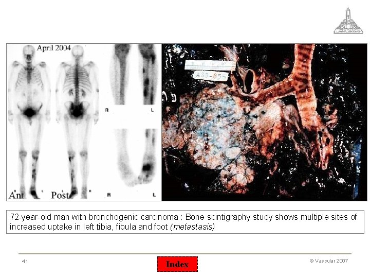 72 -year-old man with bronchogenic carcinoma : Bone scintigraphy study shows multiple sites of