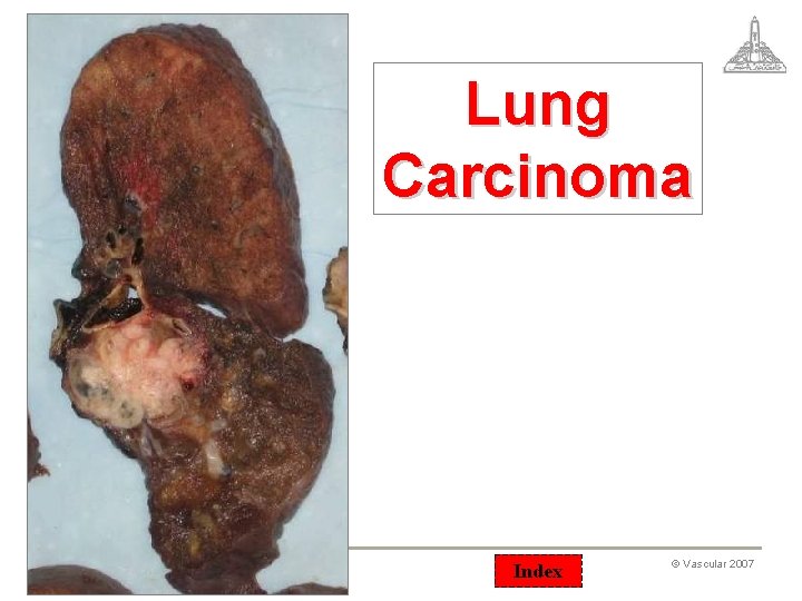 Lung Carcinoma 42 Index © Vascular 2007 