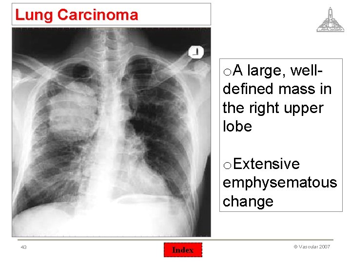 Lung Carcinoma o. A large, welldefined mass in the right upper lobe o. Extensive