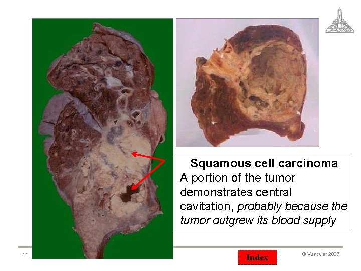 Squamous cell carcinoma A portion of the tumor demonstrates central cavitation, probably because the