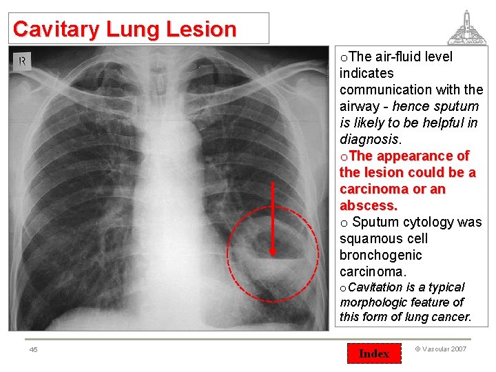 Cavitary Lung Lesion o. The air-fluid level indicates communication with the airway - hence