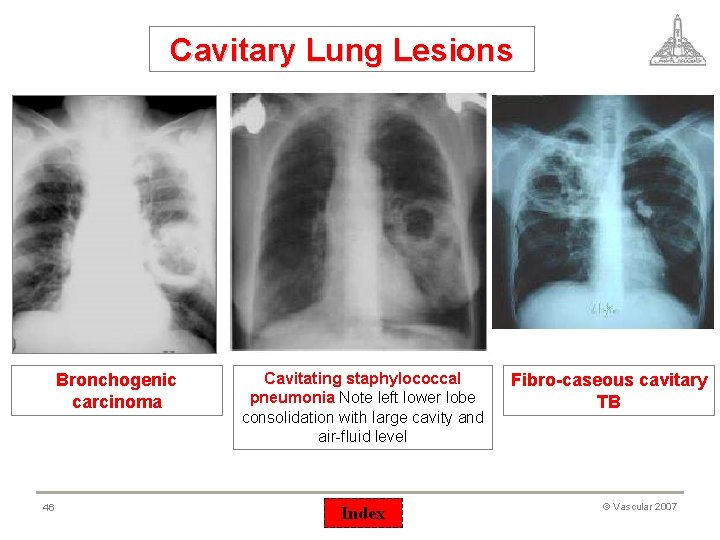 Cavitary Lung Lesions Bronchogenic carcinoma 46 Cavitating staphylococcal pneumonia Note left lower lobe consolidation