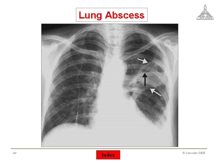 Lung Abscess 47 Index © Vascular 2008 