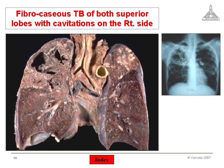 Fibro-caseous TB of both superior lobes with cavitations on the Rt. side 49 Index