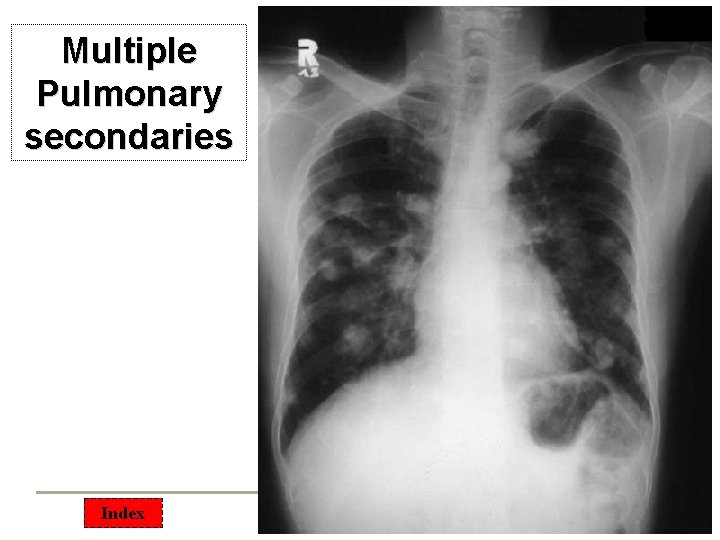 Multiple Pulmonary secondaries Index 