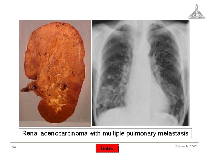 Renal adenocarcinoma with multiple pulmonary metastasis 52 Index © Vascular 2007 
