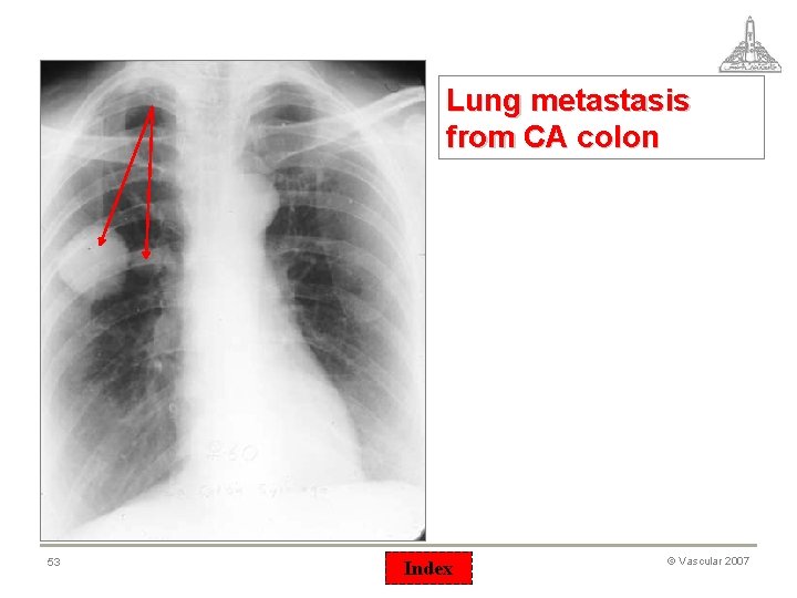 Lung metastasis from CA colon 53 Index © Vascular 2007 