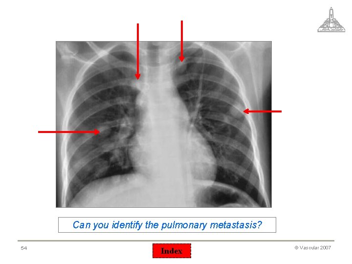 Can you identify the pulmonary metastasis? 54 Index © Vascular 2007 