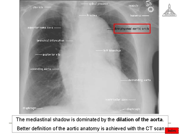 The mediastinal shadow is dominated by the dilation of the aorta. Better definition of