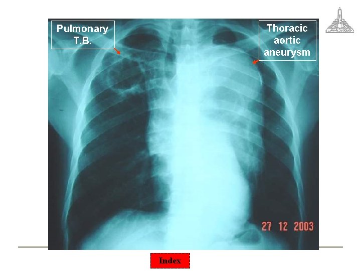 Thoracic aortic aneurysm Pulmonary T. B. Index 