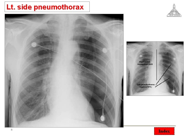 Lt. side pneumothorax 6 © Vascular 2008 Index 