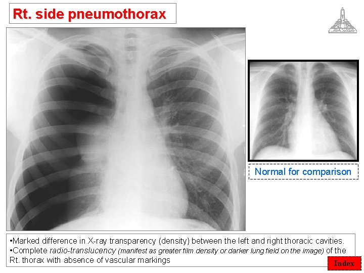 Rt. side pneumothorax Normal for comparison • Marked difference in X-ray transparency (density) between